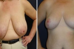Breast_Reduction_0092